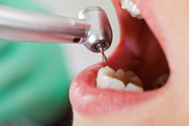 Best Chipped Tooth Repair Near Me  in Maeser, UT